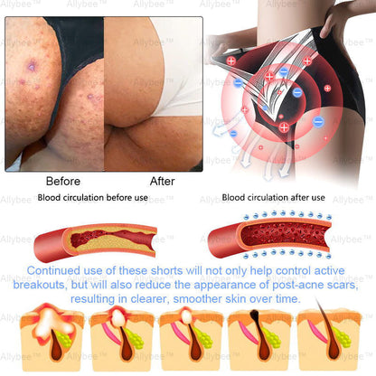 Mayo Clinic Official: Medical Grade Titanium Fiber Self-heating Tourmaline Shaping Shorts💌